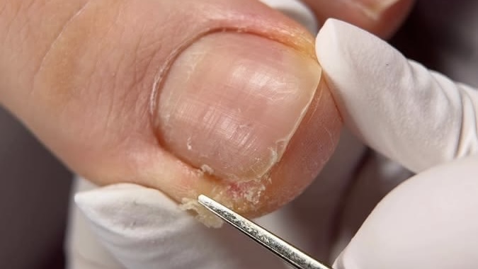 Ingrown  Image 1